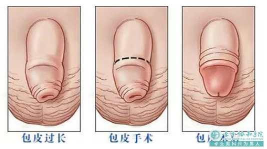 金华什么才算的包皮才算过长?华山医院割包皮怎么样?