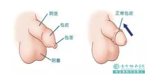 金华义乌市割完包皮硬起来什么样